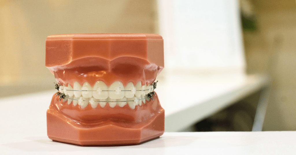 Can you play with braces? Expert